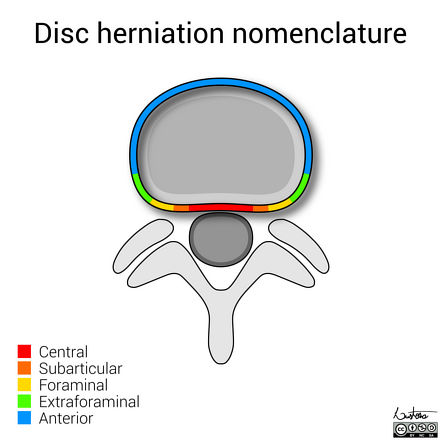 Cervical spine disc bulge