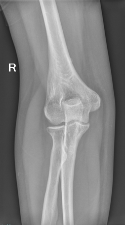 Supracondylar spur | Radiology Case | Radiopaedia.org