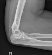 Supracondylar spur | Radiology Reference Article | Radiopaedia.org