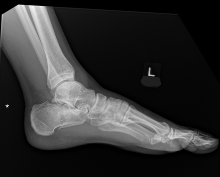 Calcaneus fracture | Radiology Case | Radiopaedia.org