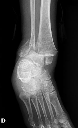 Trimalleolar ankle fracture-dislocation | Radiology Case | Radiopaedia.org