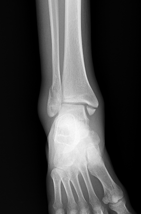 Trimalleolar ankle fracture | Radiology Case | Radiopaedia.org