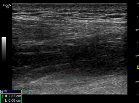 Muscle Hernias Tibialis Anterior Muscle Radiology Case Radiopaedia Org