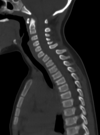 Cervical injury - bilateral interfacet dislocation | Radiology Case ...