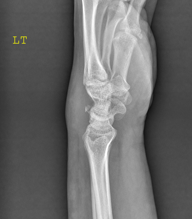 Triquetral fracture - pooping duck sign | Radiology Case | Radiopaedia.org