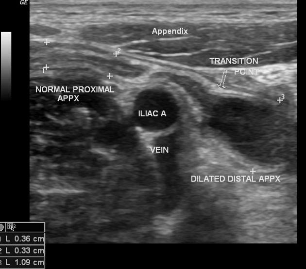 Featured image of post Acute Appendicitis Radiopaedia Symptoms commonly include right lower abdominal pain nausea vomiting and decreased appetite