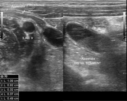 Featured image of post Radiopaedia Appendicitis Appendicitis is a condition in which the appendix becomes inflamed swollen or infected causing pain in the people with appendicitis will need surgery to remove the appendix called an appendectomy