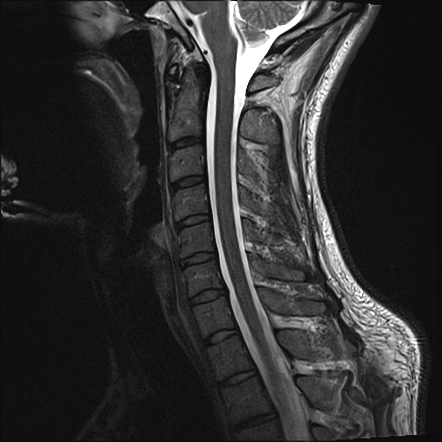 Normal Mri Cervical Spine Including T2 Sagittal Oblique Sequences