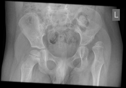 Developmental dysplasia of the hip - dynamic instability | Radiology ...