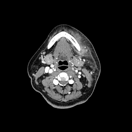 Submandibular abscess (odontogenic origin) | Radiology Case ...