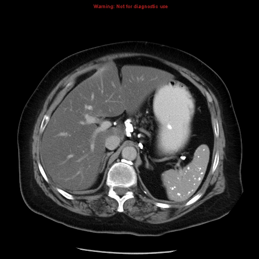 Calcified tuberculous granulomas | Image | Radiopaedia.org