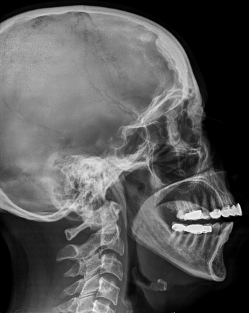 Hyperostosis frontalis interna | Radiology Case | Radiopaedia.org