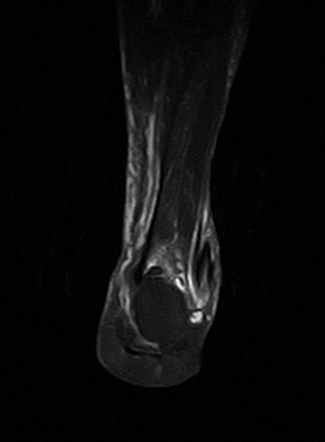 Longitudinal split tear of peroneus brevis tendon | Radiology Case ...