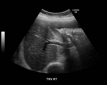 Cholelithiasis | Radiology Case | Radiopaedia.org