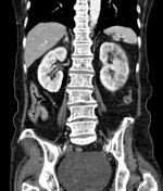 Incarcerated femoral hernia with small bowel obstruction