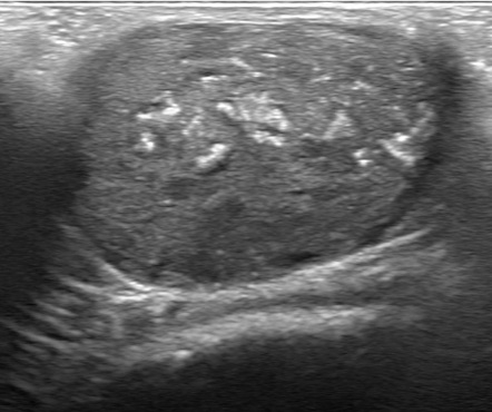 Trichilemmal cyst | Radiology Reference Article | Radiopaedia.org