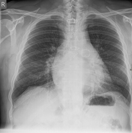 Prosthetic cardiac valves on chest x-ray (an approach) | Radiology ...