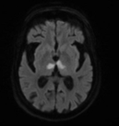 Artery of Percheron territory infarct | Radiology Case | Radiopaedia.org