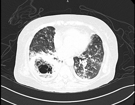 Invasive pulmonary aspergillosis | Radiology Case | Radiopaedia.org