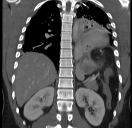 Diaphragmatic rupture | Radiology Reference Article | Radiopaedia.org