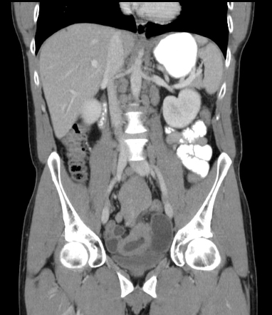 Small bowel lymphoma | Radiology Reference Article | Radiopaedia.org