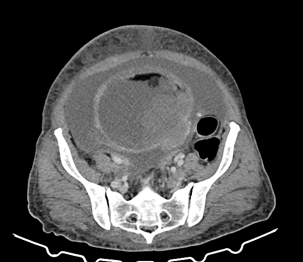 File:Malignant immature ovarian teratoma, with intraperitoneal rupture ...