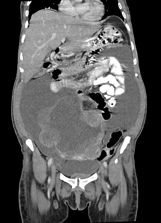 File:Malignant immature ovarian teratoma, with intraperitoneal rupture ...