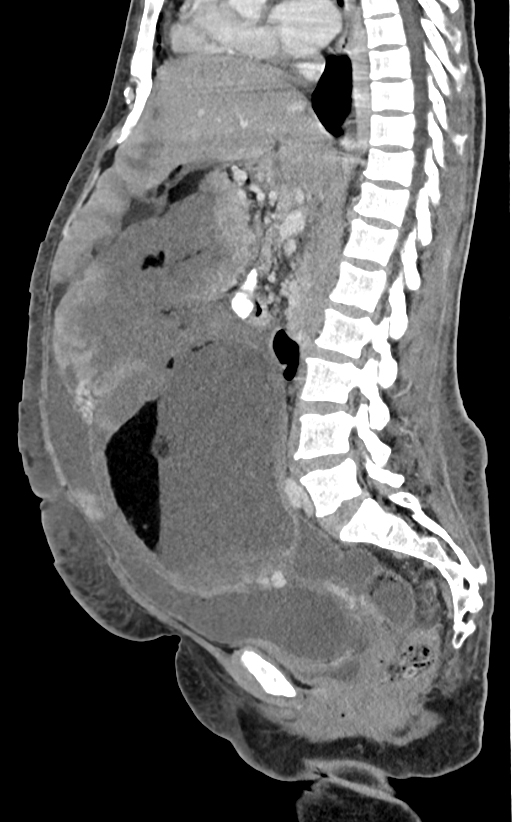 File:Malignant immature ovarian teratoma, with intraperitoneal rupture ...