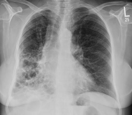 Viewing playlist: Bronchiectasis and related conditions | Radiopaedia.org