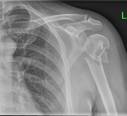 Surgical neck of humerus fracture | Radiology Case | Radiopaedia.org