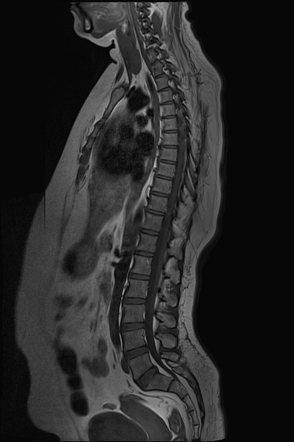 Paraspinal muscles atrophy | Radiology Case | Radiopaedia.org