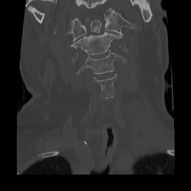 Odontoid Fracture Radiology Reference Article 5122