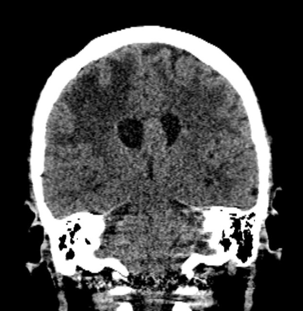 Immunodeficiency-associated CNS lymphomas | Radiology Reference Article ...