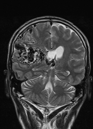 Cerebral arteriovenous malformation | Radiology Case | Radiopaedia.org