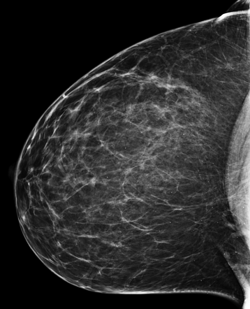 BI-RADS 1 | Radiology Case | Radiopaedia.org