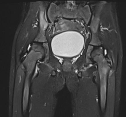 Juvenile Idiopathic Arthritis 