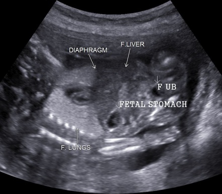 Congenital high airway obstruction syndrome | Radiology Reference ...