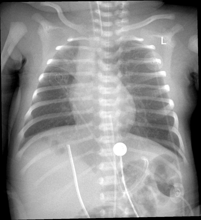 Umbilical venous catheter-related hepatic fluid collection (TPNoma) and ...