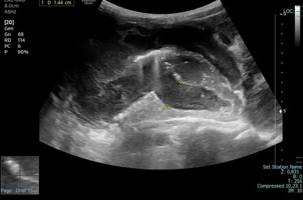 Burkitt Lymphoma 