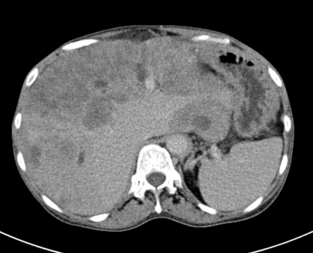 Hepatic epithelioid hemangioendothelioma | Radiology Reference Article ...