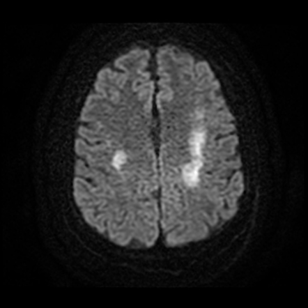 Methotrexate toxicity | Radiology Case | Radiopaedia.org