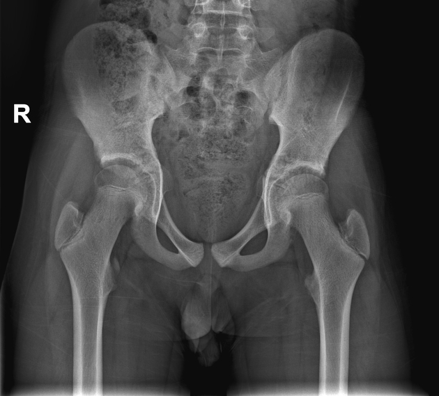 Iliac crest apophyseal avulsion fracture, Radiology Case