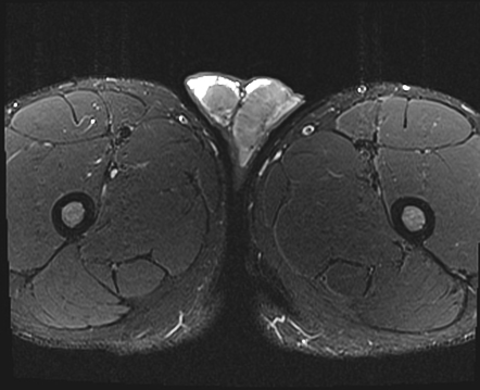 Testicular adrenal rests | Radiology Reference Article | Radiopaedia.org