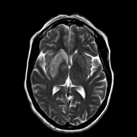 T2 hyperintense basal ganglia (mnemonic) | Radiology Reference Article ...