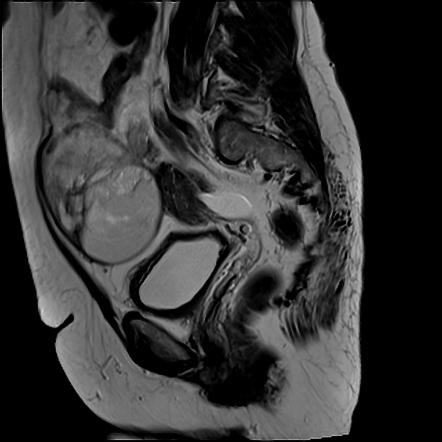 Ruptured mature cystic ovarian teratoma | Radiology Case | Radiopaedia.org