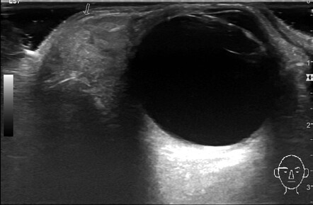 Subconjunctival fat prolapse | Radiology Case | Radiopaedia.org