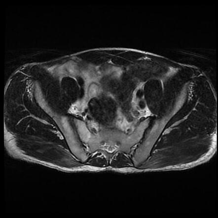 Sacroiliitis - unilateral | Radiology Case | Radiopaedia.org