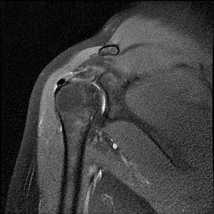 Calcific Tendinitis Supraspinatus Tendon Radiology Case