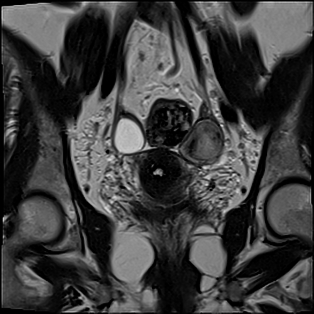 T2 Dark Spot Sign (endometrioma) | Radiology Reference Article ...