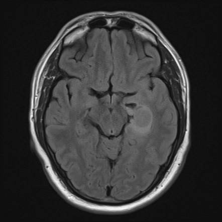 Glioblastoma, IDH-wildtype | Radiology Case | Radiopaedia.org